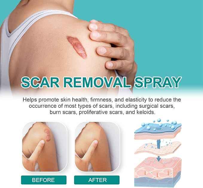 Proregen Medical Scar Removal Spray – Advanced Healing for Acne, Surgical & Burn Scars