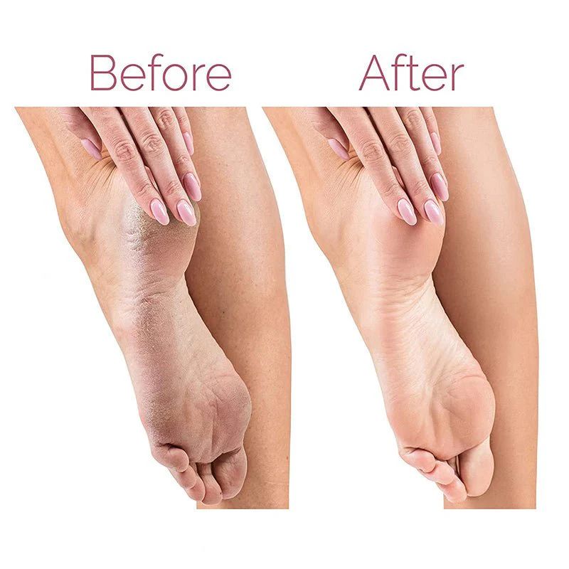 Rechargeable Electric Pedicure Foot File – Callus Remover with Dual Speed & Rollers - Infinitygallery.store