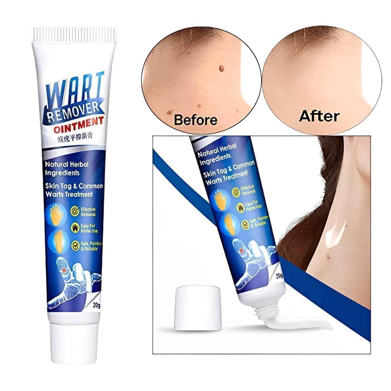 Wart & Skin Tag Remover Cream – Professional-Grade XIBLA Ointment (Home Use)