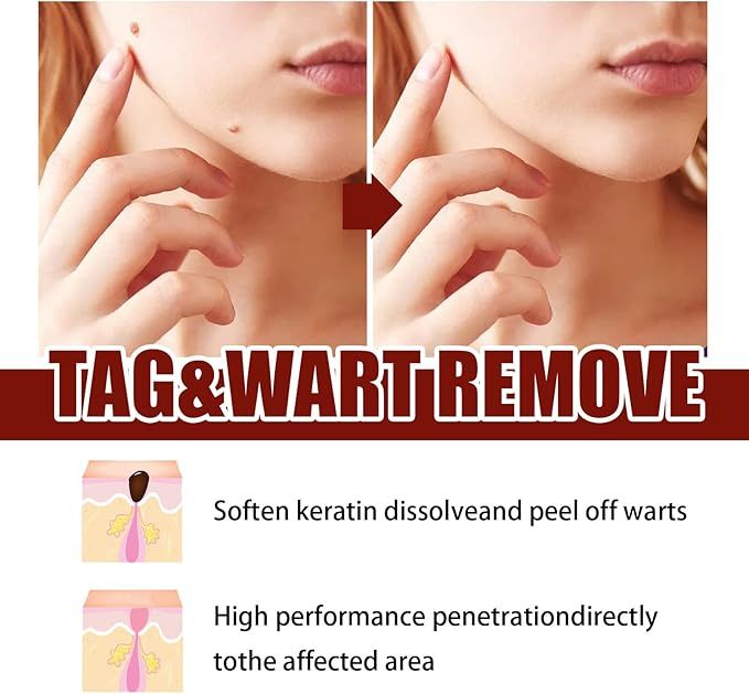 WipeOff Tag & Mole Remover Pen – Natural, Fast-Acting Skincare Solution - Infinitygallery.store