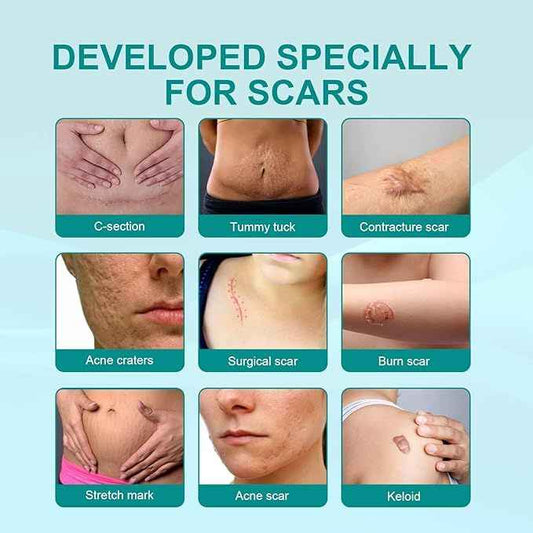 Proregen Medical Scar Removal Spray – Advanced Healing for Acne, Surgical & Burn Scars