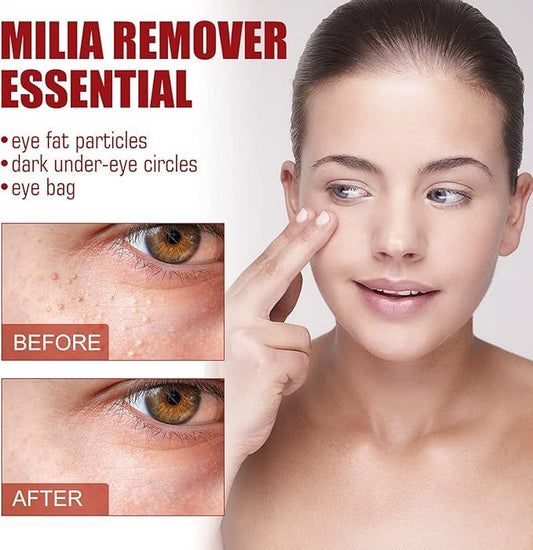 Smooth Milia Remover Serum – 30ml Gentle Skin Smoothing & Hydrating Treatment - Infinitygallery.store