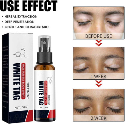 Dermax White Tag Body Moisturizing Spray – Soothes Dry, Rough & Psoriasis-Prone Skin
