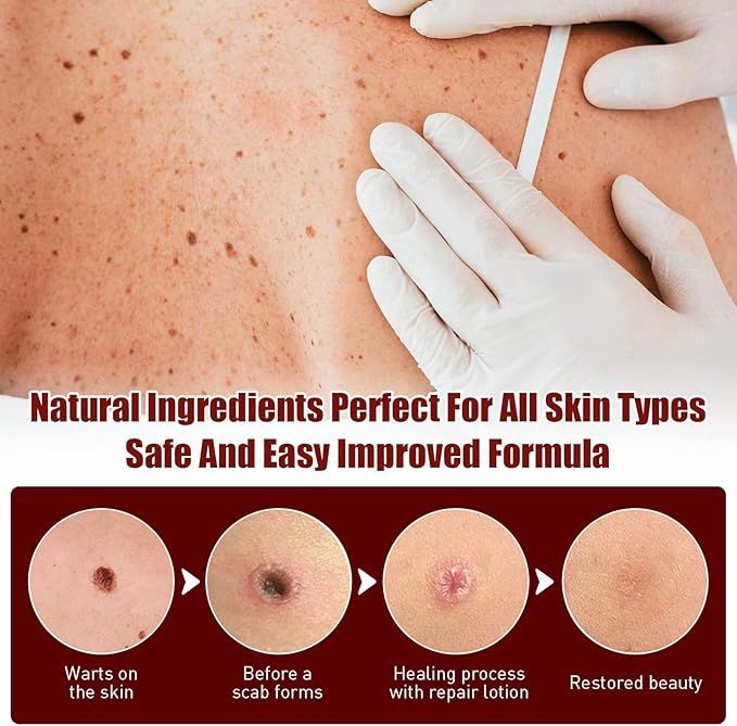 WipeOff Tag & Mole Remover Pen – Natural, Fast-Acting Skincare Solution - Infinitygallery.store