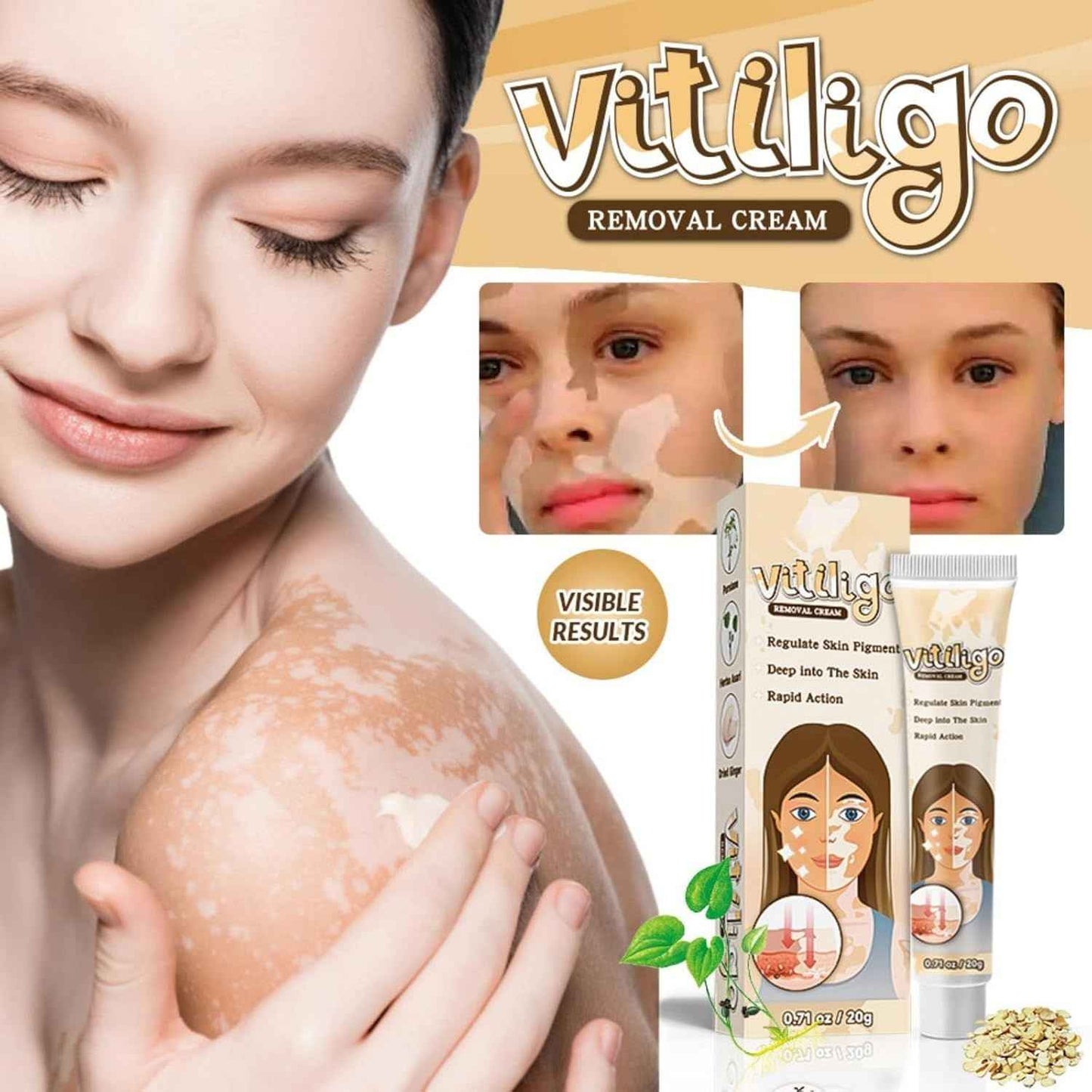 Vitiligo Removal Cream – Restore Skin Pigment & Even Skin Tone Naturally