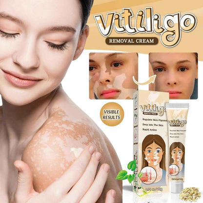 Vitiligo Removal Cream – Restore Skin Pigment & Even Skin Tone Naturally