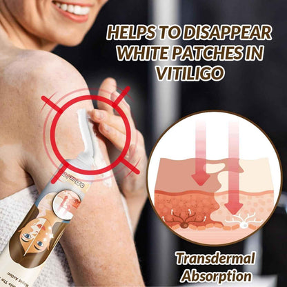 Vitiligo Removal Cream – Restore Skin Pigment & Even Skin Tone Naturally