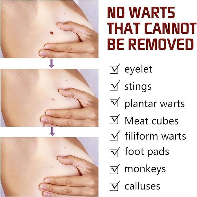 WipeOff Tag & Mole Remover Pen – Natural, Fast-Acting Skincare Solution - Infinitygallery.store