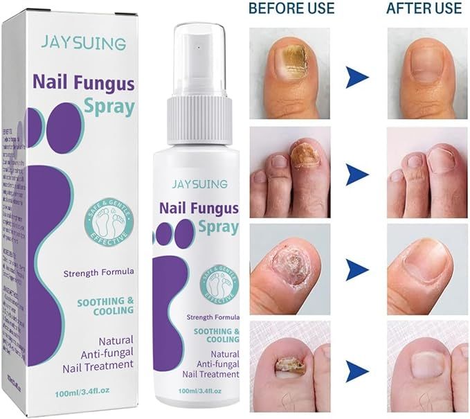 Nail Fungus Treatment Spray – Fast, Safe Relief for Hands & Feet - Infinitygallery.store