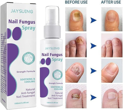 Nail Fungus Treatment Spray – Fast, Safe Relief for Hands & Feet - Infinitygallery.store