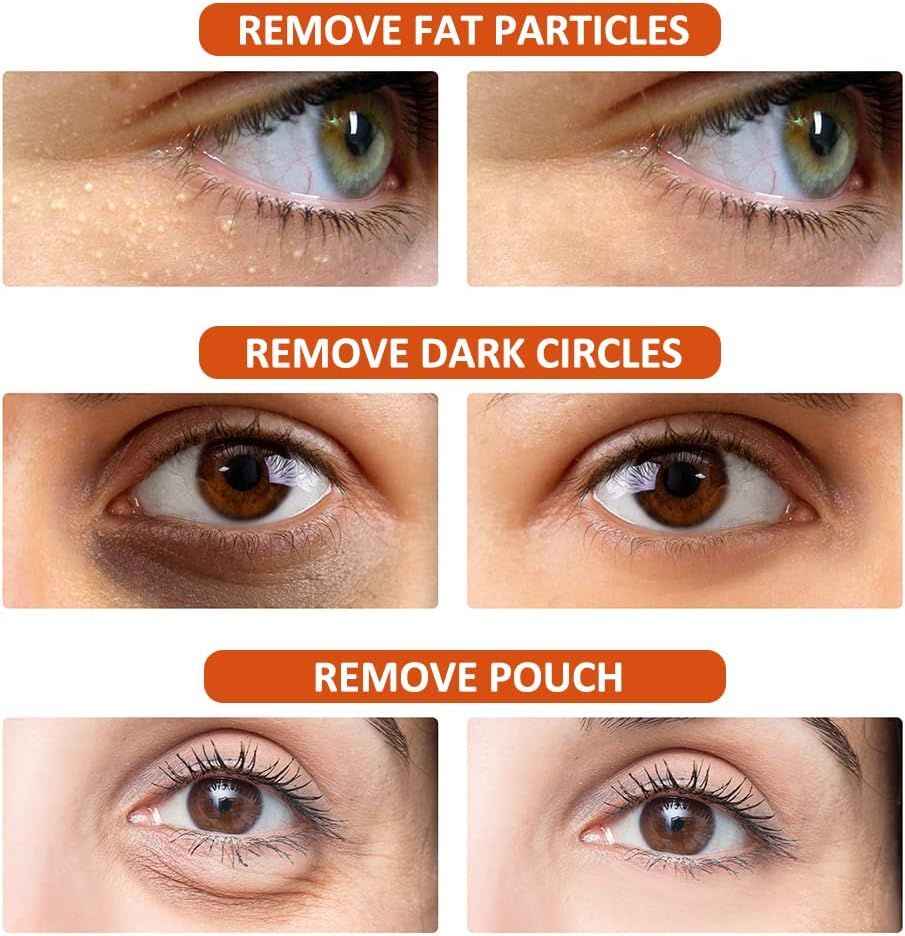 Milia Remover Essential Serum – Eye Fat Particle Removal & Hydration
