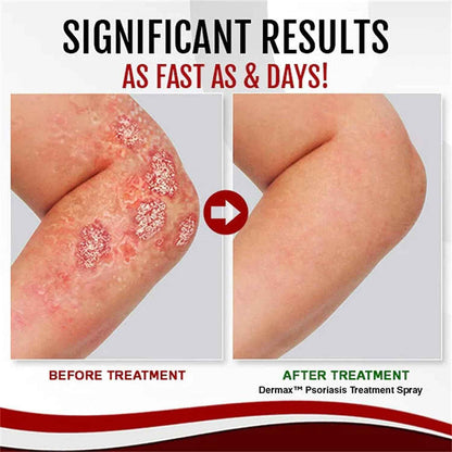 Dermax White Tag Body Moisturizing Spray – Soothes Dry, Rough & Psoriasis-Prone Skin