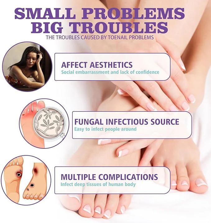 Nail Fungus Treatment Spray – Fast, Safe Relief for Hands & Feet - Infinitygallery.store