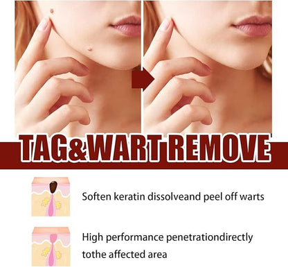 WipeOff Tag & Mole Remover Pen – Natural, Fast-Acting Skincare Solution - Infinitygallery.store