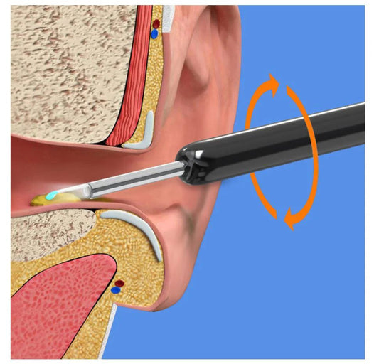 Wireless HD Earwax Removal Kit with Camera – iOS & Android Compatible, Type-C Rechargeable - Infinitygallery.store