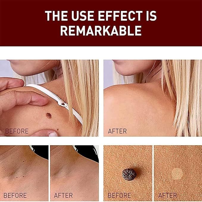 WipeOff Tag & Mole Remover Pen – Natural, Fast-Acting Skincare Solution - Infinitygallery.store