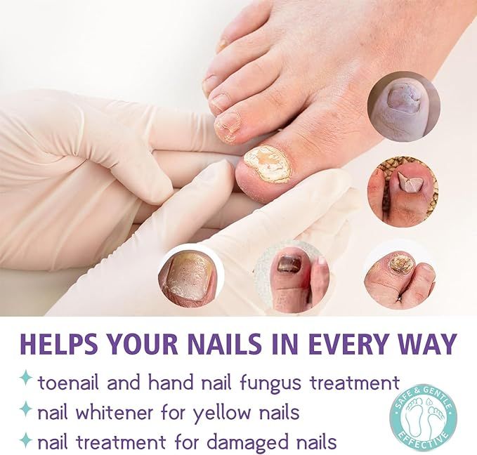 Nail Fungus Treatment Spray – Fast, Safe Relief for Hands & Feet - Infinitygallery.store