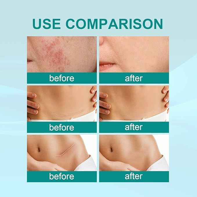 Proregen Medical Scar Removal Spray – Advanced Healing for Acne, Surgical & Burn Scars