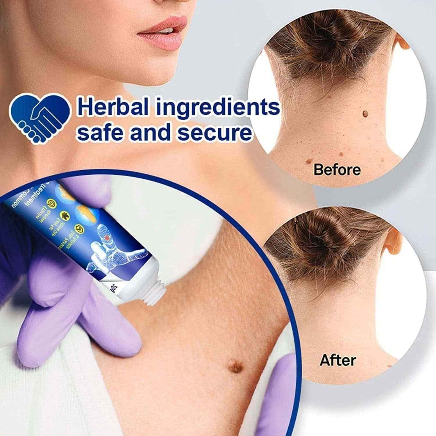 Wart & Skin Tag Remover Cream – Professional-Grade XIBLA Ointment (Home Use)