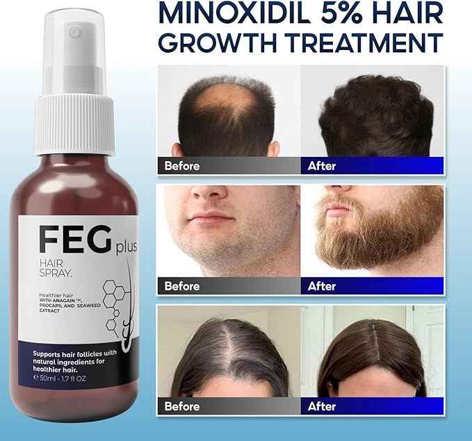 Hair Growth Spray PLUS with 5% Minoxidil – Accelerates Growth & Reduces Thinning (Original)
